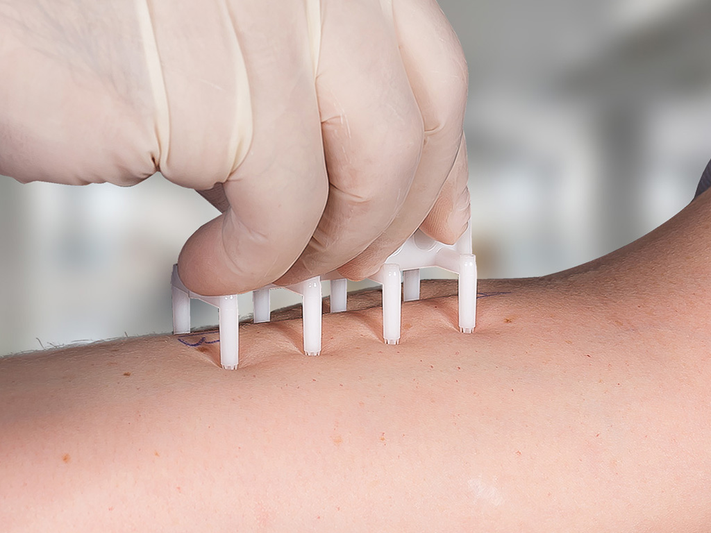 Prick Test sendo realizado no braço do paciente